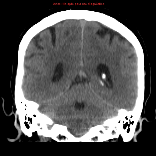File:Aneurysmal subarachnoid hemorrhage (Radiopaedia 24740-24997 Coronal non-contrast 32).jpg