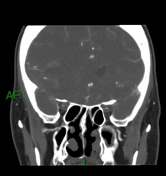Aneurysmal subarachnoid hemorrhage with intra-axial extension (Radiopaedia 84371-99732 C 67).jpg