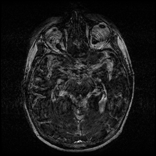 Angioinvasive aspergillosis in the pituitary fossa (Radiopaedia 39676-42010 Ax 3D FIESTA VOLUME 72).png