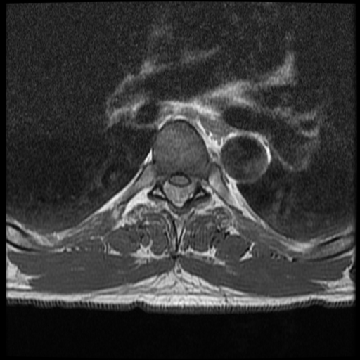 File:Angiolipoma - thoracic spine (Radiopaedia 28242-28479 Axial T1 15).jpg