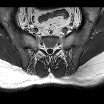 File:Ankylosing spondylitis with zygapophyseal arthritis (Radiopaedia 38433-40517 B 5).jpg