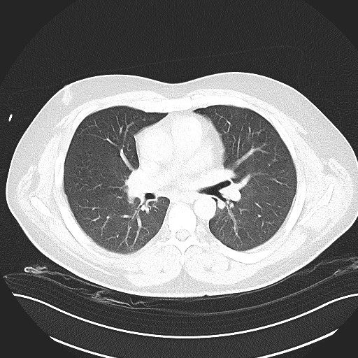 File:Anomalous origin of the left coronary artery with malignant course (Radiopaedia 77842-90126 Axial lung window 17).jpeg