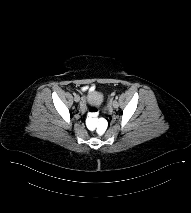 Anterior abdominal wall CSF pseudocyst (CSFoma) (Radiopaedia 79453-92571 A 78).jpg
