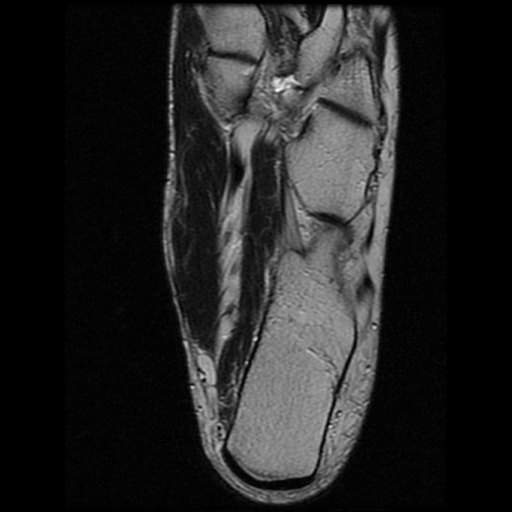 File:Anterior calcaneal process fracture (Radiopaedia 74654-85611 Axial T2 23).jpg