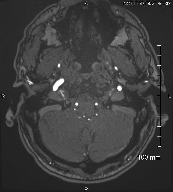 Anterior cerebral artery aneurysm (Radiopaedia 80683-94127 Axial MRA 23).jpg