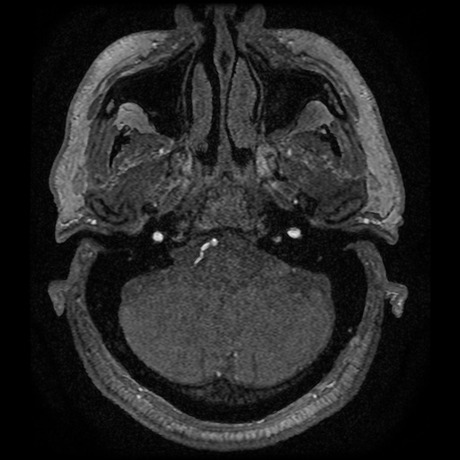 Anterior cerebral artery infarction (Radiopaedia 46794-51323 Axial MRA 9).jpg