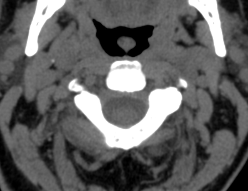 Anterior cervical postdiscectomy arthrodesis (Radiopaedia 32678-33646 Axial non-contrast 22).jpg
