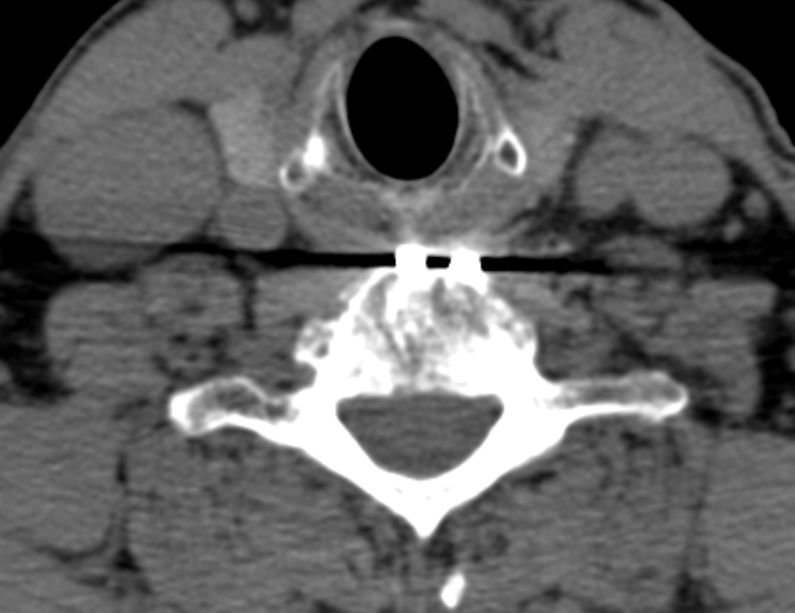 Anterior cervical postdiscectomy arthrodesis (Radiopaedia 32678-33646 Axial non-contrast 56).jpg