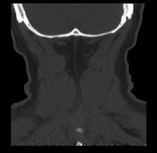 Anterior cervical postdiscectomy arthrodesis (Radiopaedia 32678-33646 Coronal bone window 70).jpg