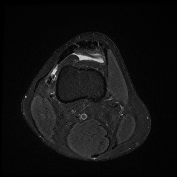 File:Anterior cruciate ligament graft tear and bucket-handle tear of medial meniscus (Radiopaedia 75867-87254 Axial PD fat sat 25).jpg