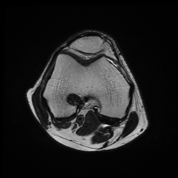 File:Anterior cruciate ligament graft tear and bucket-handle tear of medial meniscus (Radiopaedia 75867-87254 Axial T2 16).jpg