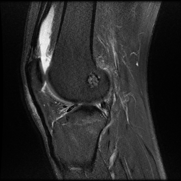 File:Anterior cruciate ligament graft tear and bucket-handle tear of medial meniscus (Radiopaedia 75867-87255 Sagittal PD fat sat 18).jpg