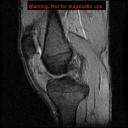 File:Anterior cruciate ligament injury - partial thickness tear (Radiopaedia 12176-12515 A 8).jpg