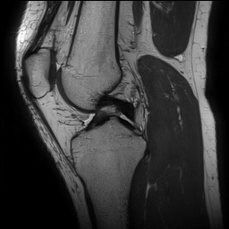 Anterior cruciate ligament rupture and posteromedial corner injury (Radiopaedia 67338-76723 Sagittal PD 78).jpg