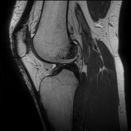 Anterior cruciate ligament rupture and posteromedial corner injury (Radiopaedia 67338-76723 Sagittal PD 97).jpg