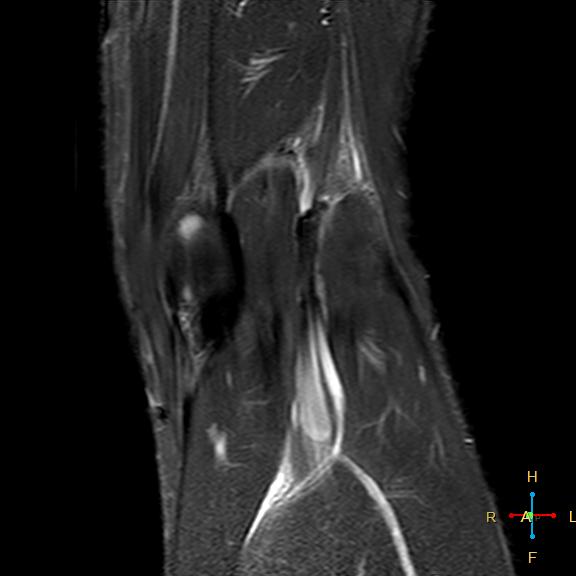 File:Anterior cruciate ligament tear - complete (Radiopaedia 24907-25170 Coronal STIR 18).jpg