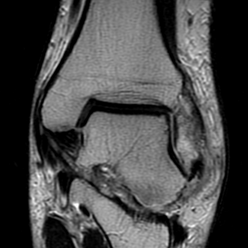 File:Anterior talofibular ligament rupture (Radiopaedia 15831-15484 Coronal T2 11).jpg
