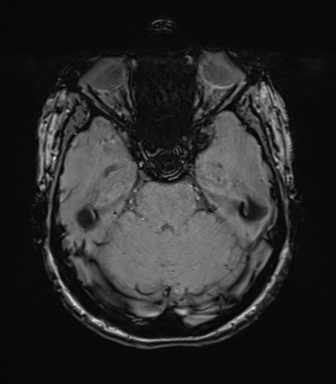 File:Anterior temporal lobe perivascular space (Radiopaedia 40946-43650 Axial SWI 27).png