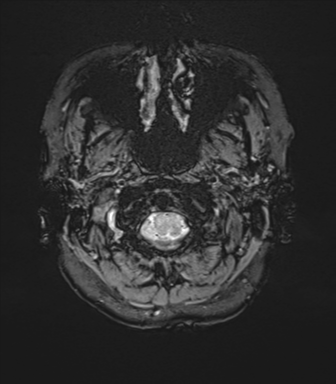 Anterior temporal lobe perivascular space (Radiopaedia 40946-43650 Axial SWI 3).png
