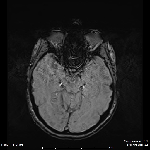 File:Anterior temporal lobe perivascular space (Radiopaedia 88283-104914 Axial SWI 15).jpg