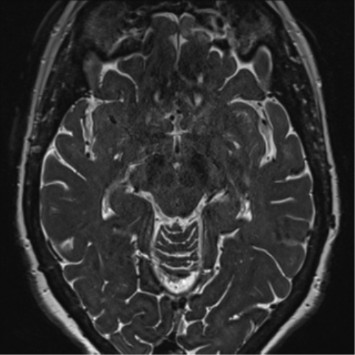 File:Anterior temporal pole cysts (Radiopaedia 46629-51102 Axial 59).png