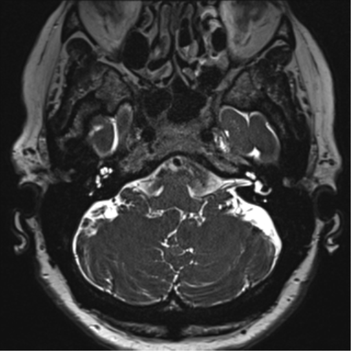 Anterior temporal pole cysts (Radiopaedia 46629-51102 Axial T2 27).png