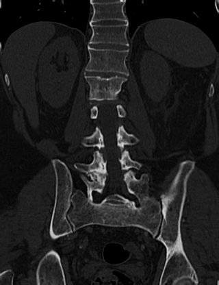 Anterior vertebral scalloping (abdominal aortic aneurysm) (Radiopaedia 66744-76067 Coronal bone window 46).jpg