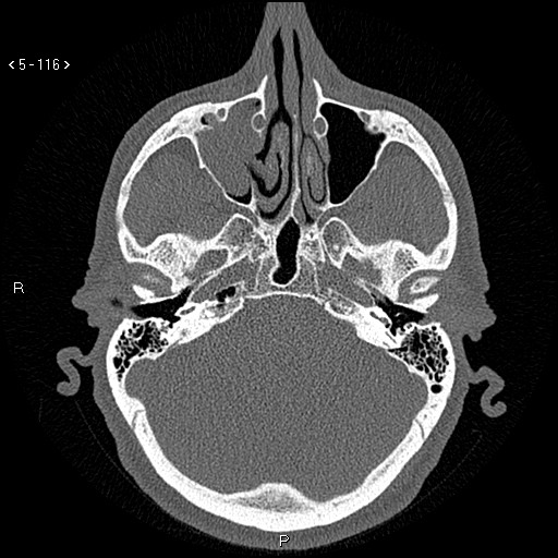 Antrochoanal Polyp (Radiopaedia 70510-80631 Axial bone window 64).jpg