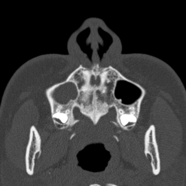 Antrochoanal polyp (Radiopaedia 33984-35202 Axial bone window 8).jpg