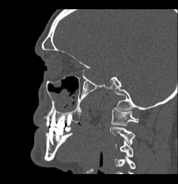 Antrochoanal polyp (Radiopaedia 79011-92169 Sagittal bone window 8).jpg