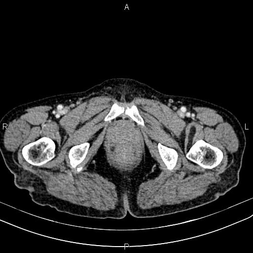 File:Aortic aneurysm and Lemmel syndrome (Radiopaedia 86499-102554 A 85).jpg