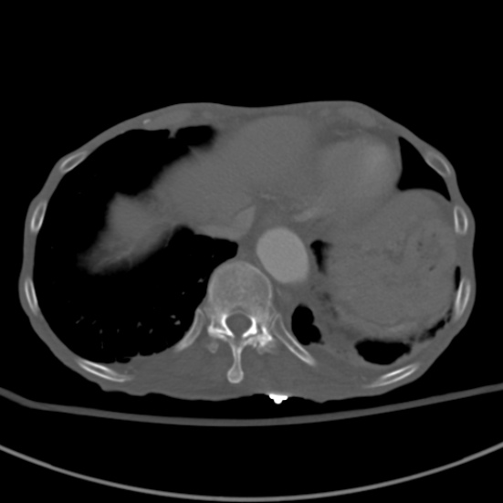 Aortic aneurysm with spinal destruction (Radiopaedia 42301-45410 Axial bone window 10).jpg