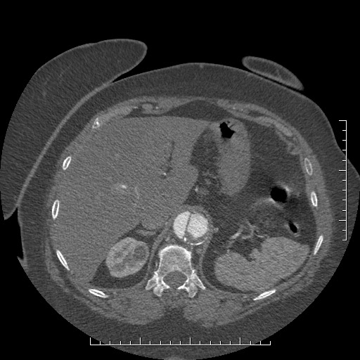 Aortic dissection- Stanford A (Radiopaedia 35729-37268 B 35).jpg