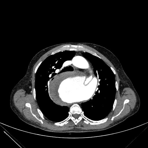 Aortic dissection (Radiopaedia 27466-27665 C+ arterial phase 78).jpg