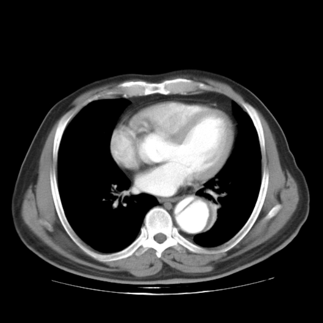 Aortic dissection (Radiopaedia 44411-48061 C 16).jpg