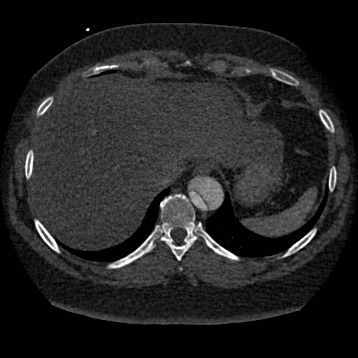 File:Aortic dissection (Radiopaedia 57969-64959 A 258).jpg