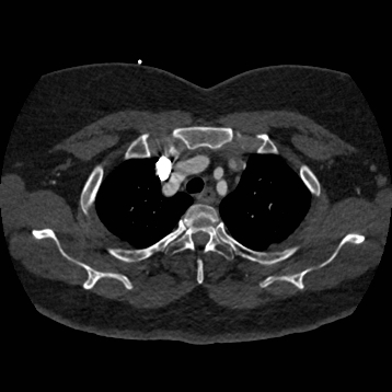 Aortic dissection (Radiopaedia 57969-64959 A 66).jpg