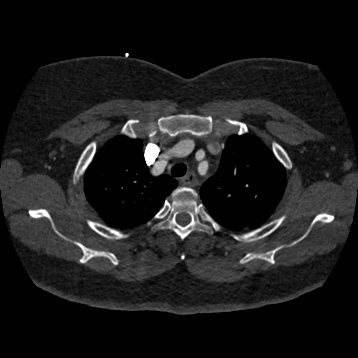 File:Aortic dissection (Radiopaedia 57969-64959 A 70).jpg