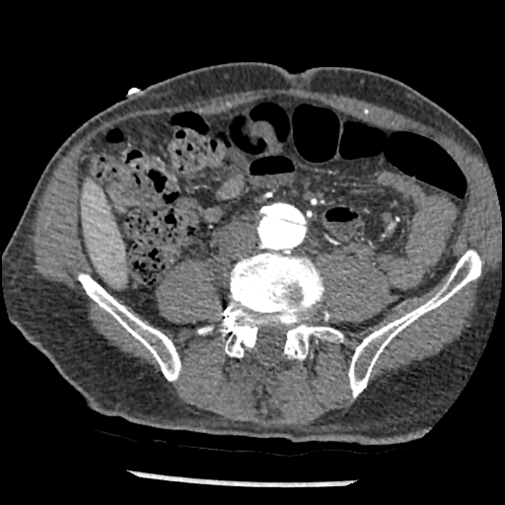 Aortic dissection - DeBakey Type I-Stanford A (Radiopaedia 79863-93115 A 62).jpg