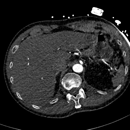 File:Aortic dissection - DeBakey type II (Radiopaedia 64302-73082 A 87).png