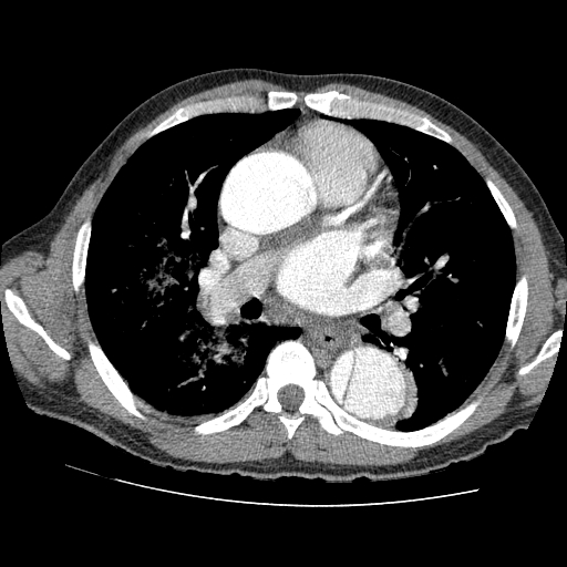 File:Aortic dissection - Stanford A -DeBakey I (Radiopaedia 28339-28587 B 45).jpg