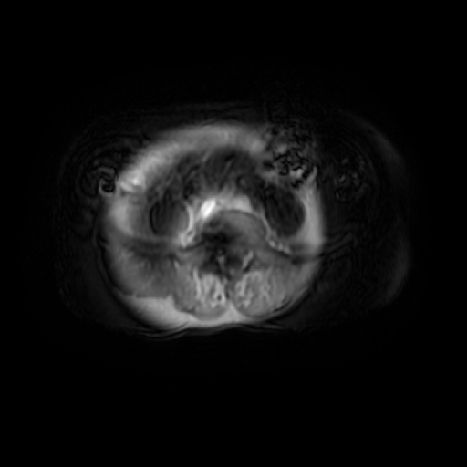 File:Aortic dissection - Stanford A - DeBakey I (Radiopaedia 23469-23551 Axial MRA 72).jpg