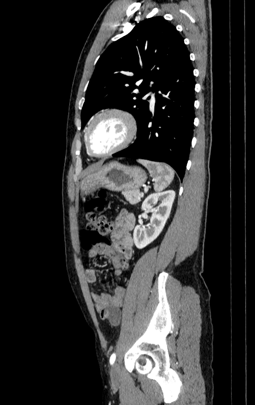 Aortic dissection - Stanford type A (Radiopaedia 83418-98500 B 74).jpg
