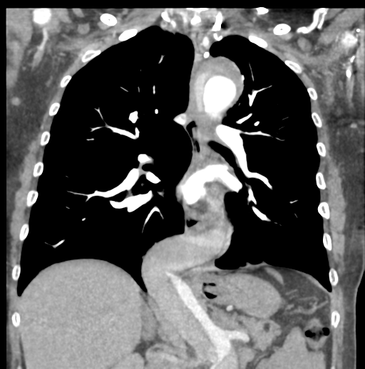 Aortic dissection - Stanford type B (Radiopaedia 50171-55512 B 48).png
