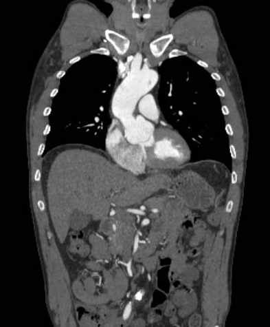 File:Aortic dissection - Stanford type B (Radiopaedia 73648-84437 B 46).jpg