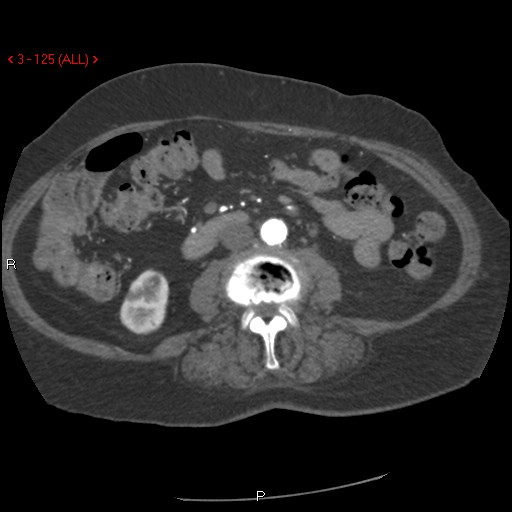Aortic intramural hematoma (Radiopaedia 27746-28001 A 125).jpg