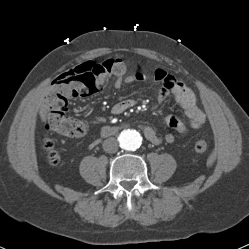 Aortic intramural hematoma (Radiopaedia 31139-31838 B 118).jpg