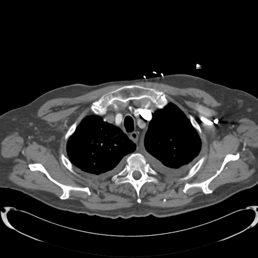 Aortic intramural hematoma (Radiopaedia 34260-35540 B 4).png