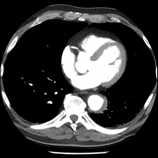 Aortic intramural hematoma (type B) (Radiopaedia 79323-92387 B 36).jpg