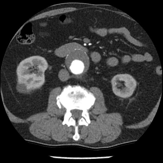 Aortic intramural hematoma (type B) (Radiopaedia 79323-92387 B 73).jpg